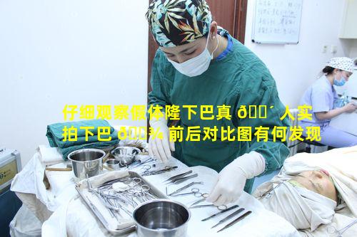 仔细观察假体隆下巴真 🐴 人实拍下巴 🌾 前后对比图有何发现